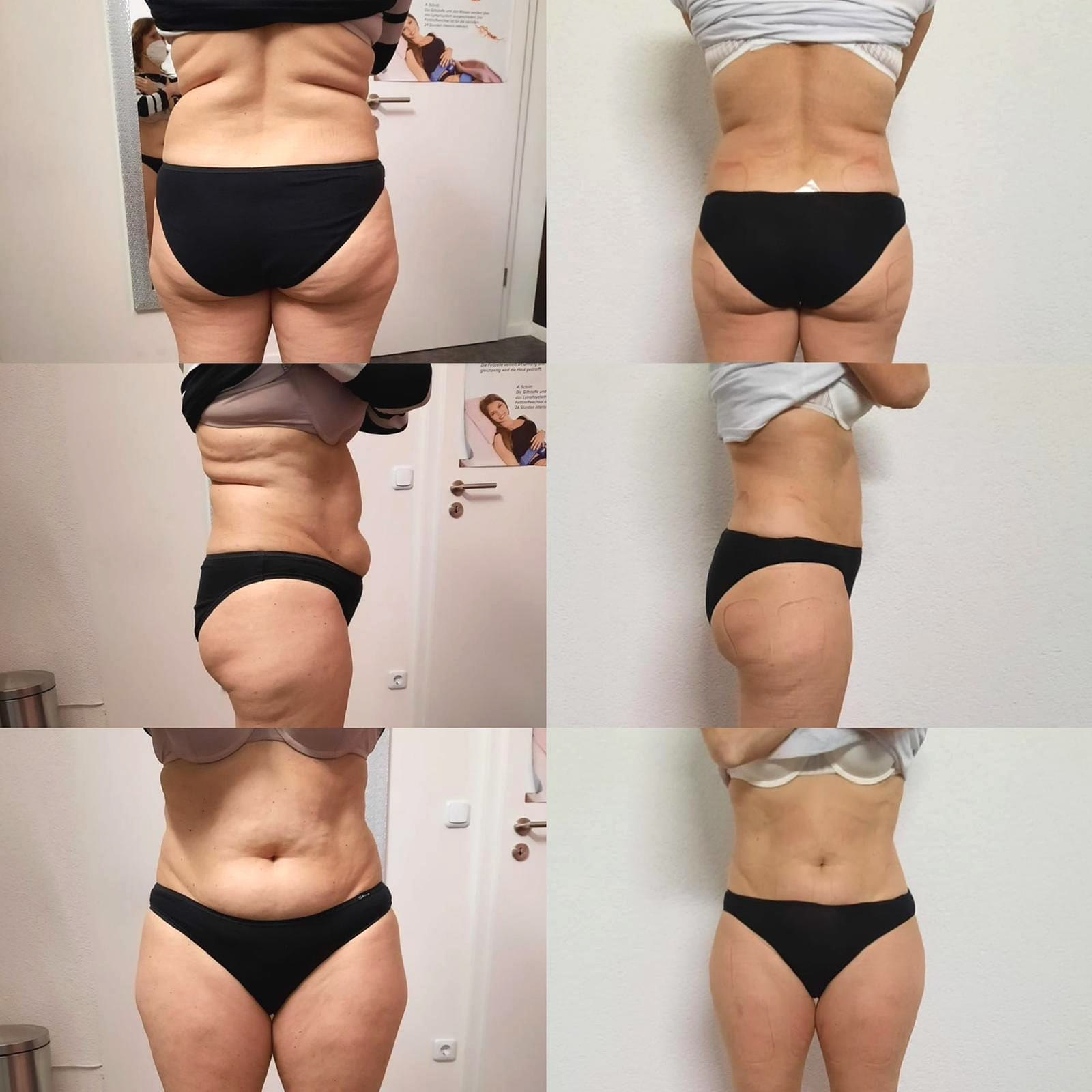 Vorher/Nachher am Körper: Bauch, Taille und Po zeigen nach mehreren Bodyforming-Behandlungen eine sichtbar straffere Kontur